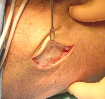 Die Salbe oder die Kerzen von der Hämorrhoide mit dem schmerzstillenden Effekt
