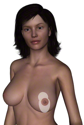 Trazado de las incisiones en la reducción mamaria en forma de i