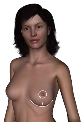 Рубцы, возникающие после уменьшения груди посредством Т-образного разреза