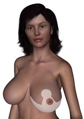 Trazado de la incisión en la reducción de senos en forma de T