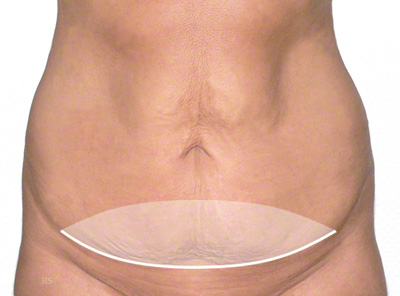 Mini-plastia del vientre, en medicina mini-abdominoplastia