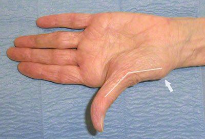Rhizarthrose, Daumensattelgelenksarthrose
