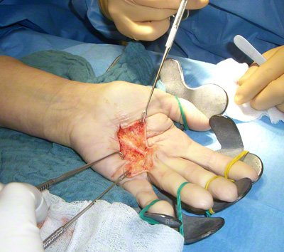 Operation bei Morbus Dupuytren