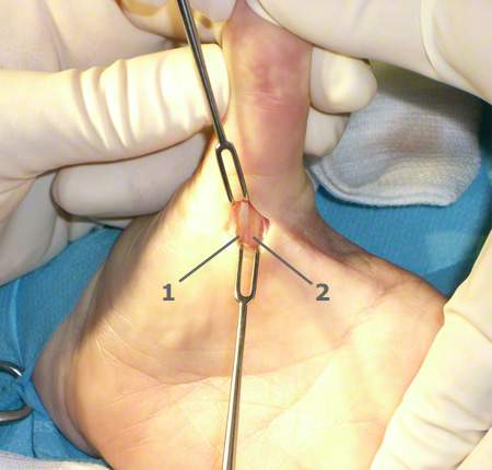 Schnappfinger: schnellender finger - schnappfinger-operation bei