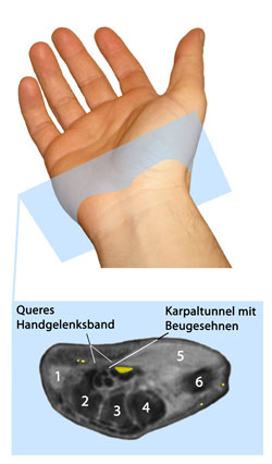 Karpaltunnel-Anatomie mit Nervus Medianus und Beugesehnen
