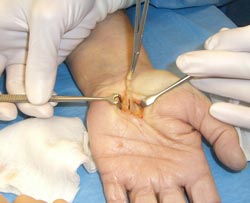 Sehnenscheidenentzuendung Operation